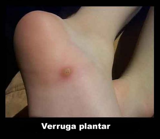 Tratamento de pregos reforçados propolis